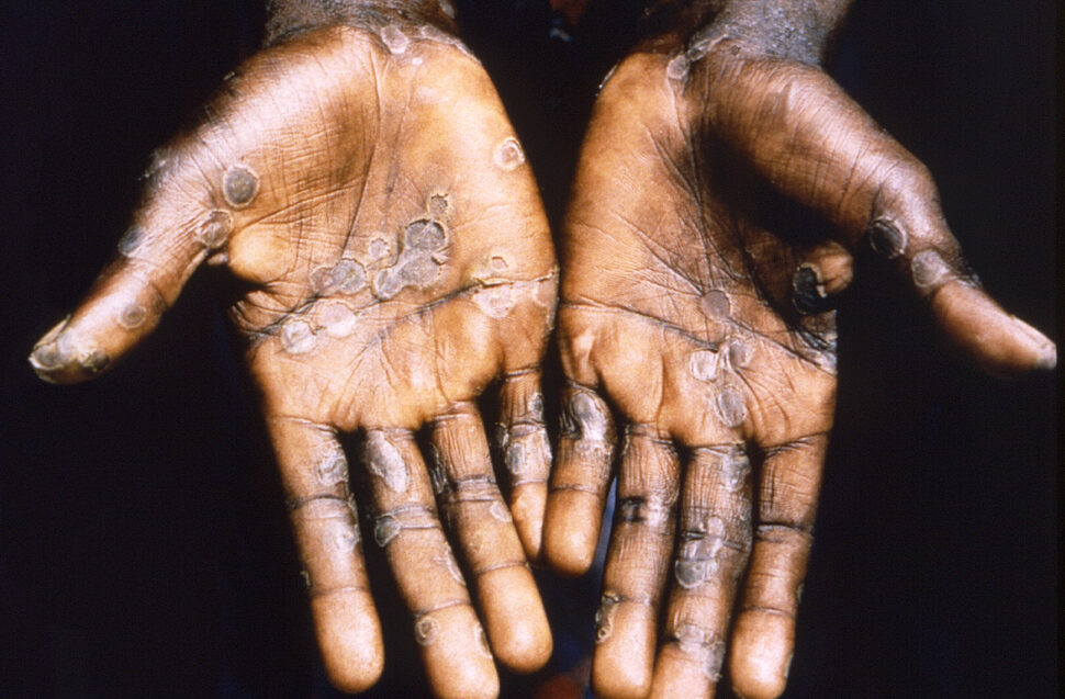 Monkeypox Travel Tips pictured: monkeypox rash